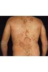 Psoriasi Volgare
