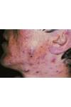 Acne Volgare