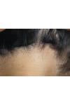 Alopecia Androgenetica