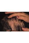Alopecie Cicatriziali Acquisite