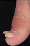 Ipertrofia