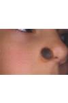 Nevo Melanocitico Congenito