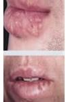 Herpes Simplex